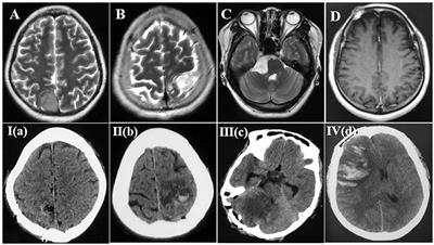 Hemorrhagic cerebral venous infarction after vein injury during intraoperative lesion resection: incidence, hemorrhagic stages, risk factors and prognosis